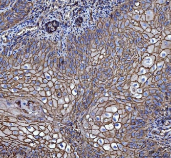 IHC staining of FFPE human laryngeal squamous cell carcinoma tissue with Emmprin antibody. HIER: boil tissue sections in pH8 EDTA for 20 min and allow to cool before testing.