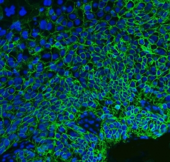 Immunofluorescent staining of FFPE human esophageal squamous carcinoma tissue with Basigin antibody (green) and DAPI nuclear stain (blue). HIER: steam section in pH8 EDTA buffer for 20 min.