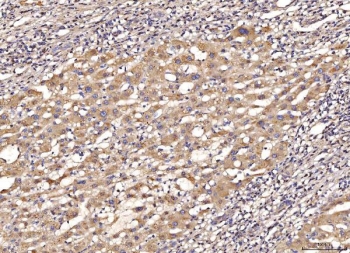 IHC staining of FFPE human liver cancer tissue with MYD88 antibody. HIER: boil tissue sections in pH8 EDTA for 20 min and allow to cool before testing.