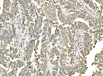 IHC staining of FFPE human rectal cancer tissue with ERp57 antibody. HIER: boil tissue sections in pH8 EDTA for 20 min and allow to cool before testing.