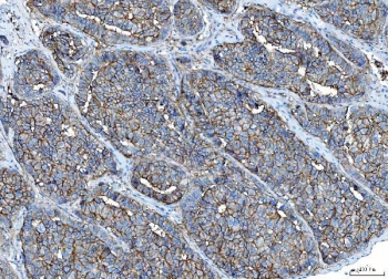 IHC staining of FFPE human liver cancer tissue with Poliovirus Receptor antibody. HIER: boil tissue sections in pH8 EDTA for 20 min and allow to cool before testing.
