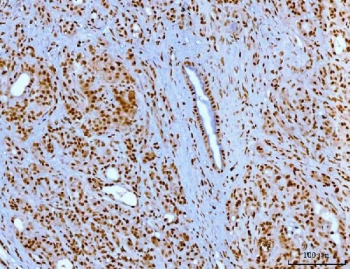 IHC staining of FFPE human pancreatic ductal adenocarcinoma tissue with YY1 antibody. HIER: boil tissue sections in pH8 EDTA for 20 min and allow to cool before testing.