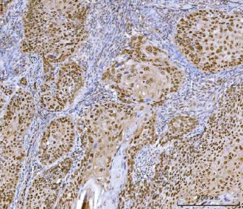 IHC staining of FFPE human laryngeal squamous cell carcinoma tissue with Homeobox protein cut-like 1 antibody. HIER: boil tissue sections in pH8 EDTA for 20 min and allow to cool before testing.