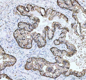 IHC staining of FFPE human prostate cancer tissue with Junctional adhesion molecule A antibody. HIER: boil tissue sections in pH8 EDTA for 20 min and allow to cool before testing.