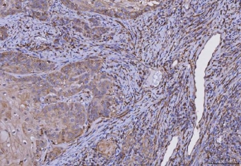 IHC staining of FFPE human laryngeal squamous cell carcinoma tissue with HLA-DRA antibody. HIER: boil tissue sections in pH8 EDTA for 20 min and allow to cool before testing.