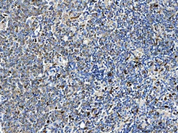 IHC staining of FFPE human B lymphocytic tumor tissue with ARHGAP45 antibody. HIER: boil tissue sections in pH8 EDTA for 20 min and allow to cool before testing.