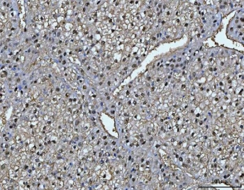 IHC staining of FFPE human liver cancer tissue with Fumarylacetoacetate hydrolase antibody. HIER: boil tissue sections in pH8 EDTA for 20 min and allow to cool before testing.