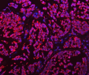Immunofluorescent staining of FFPE human breast cancer tissue with GLUD1/2 antibody (red) and DAPI nuclear stain (blue). HIER: boil tissue sections in pH8 EDTA for 20 min and allow to cool before testing.