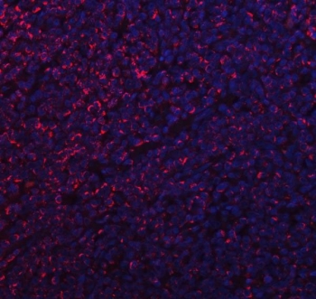 Immunofluorescent staining of FFPE human lymphoma tissue with Mitochondrial fission factor antibody (red) and DAPI nuclear stain (blue). HIER: steam section in pH8 EDTA buffer for 20 min.