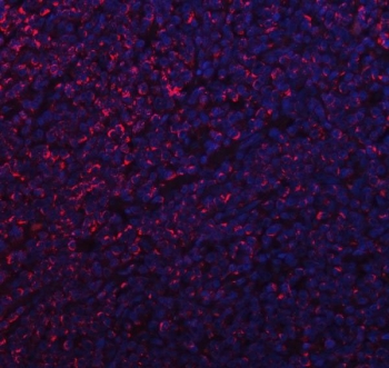 Immunofluorescent staining of FFPE human lymphoma tissue with Mitochondrial fission factor antibody (red) and DAPI nuclear stain (blue). HIER: steam section in pH8 EDTA buffer for 20 min.