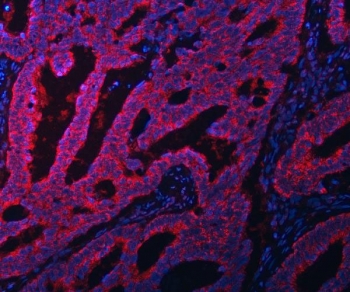 Immunofluorescent staining of FFPE human intestinal cancer tissue with EIF3A antibody (red) and DAPI nuclear stain (blue). HIER: steam section in pH8 EDTA buffer for 20 min.