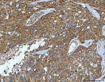 IHC staining of FFPE human squamous carcinoma tissue with CAD Protein antibody. HIER: boil tissue sections in pH8 EDTA for 20 min and allow to cool before testing.
