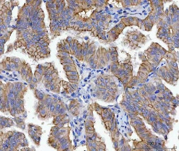 IHC staining of FFPE human lung adenocarcinoma tissue with JUP antibody. HIER: boil tissue sections in pH8 EDTA for 20 min and allow to cool before testing.