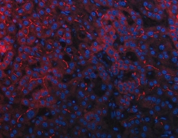 Immunofluorescent staining of FFPE human liver cancer tissue with DEP1 antibody (red) and DAPI nuclear stain (blue). HIER: steam section in pH8 EDTA buffer for 20 min.
