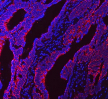 Immunofluorescent staining of FFPE human colorectal adenocarcinoma tissue with NDUFS5 antibody (red) and DAPI nuclear stain (blue). HIER: steam section in pH8 EDTA buffer for 20 min.