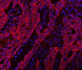 Immunofluorescent staining of FFPE human colorectal adenocarcinoma tissue with CLASP1 antibody (red) and DAPI nuclear stain (blue). HIER: steam section in pH8 EDTA buffer for 20 min.