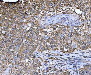 IHC staining of FFPE human lung squamous cell carcinoma tissue with LIMA1 antibody. HIER: boil tissue sections in pH8 EDTA for 20 min and allow to cool before testing.