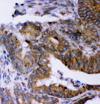 IHC staining of FFPE human colorectal adenocarcinoma tissue with AEG-1 antibody. HIER: boil tissue sections in pH8 EDTA for 20 min and allow to cool before testing.