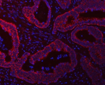 Immunofluorescent staining of FFPE human intestine cancer tissue with SCO1 antibody (red) and DAPI nuclear stain (blue). HIER: steam section in pH8 EDTA buffer for 20 min.