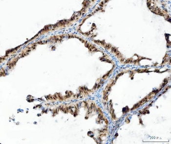 IHC staining of FFPE human ovarian cancer tissue with UBA6 antibody. HIER: boil tissue sections in pH8 EDTA for 20 min and allow to cool before testing.