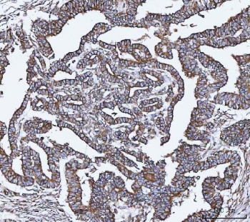 IHC staining of FFPE human cervical cancer tissue with VAPA antibody. HIER: boil tissue sections in pH8 EDTA for 20 min and allow to cool before testing.