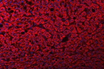 Immunofluorescent staining of FFPE human liver cancer tissue with FRY antibody (red) and DAPI nuclear stain (blue). HIER: steam section in pH8 EDTA buffer for 20 min.