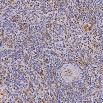 IHC staining of FFPE human spleen cancer tissue with IL2-inducible T-cell kinase antibody. HIER: boil tissue sections in pH8 EDTA for 20 min and allow to cool before testing.