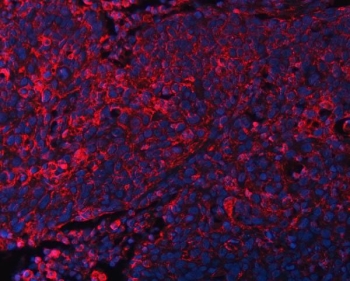 Immunofluorescent staining of FFPE human esophageal squamous cell carcinoma tissue with DOCK1 antibody (red) and DAPI nuclear stain (blue). HIER: boil tissue sections in pH8 EDTA for 20 min and allow to cool before testing.