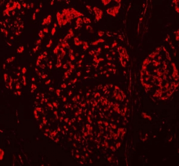 Immunofluorescent staining of FFPE human breast cancer tissue with TBX18 antibody (red). HIER: steam section in pH8 EDTA buffer for 20 min.