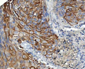 IHC staining of FFPE human lung squamous cell carcinoma tissue with S100A14 antibody. HIER: boil tissue sections in pH8 EDTA for 20 min and allow to cool before testing.