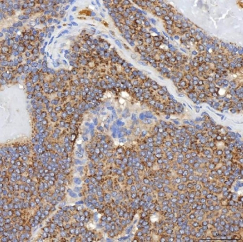 IHC staining of FFPE human breast cancer tissue with SGCE antibody. HIER: boil tissue sections in pH8 EDTA for 20 min and allow to cool before testing.