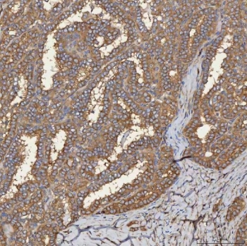 IHC staining of FFPE human thyroid cancer tissue with SEC31A antibody. HIER: boil tissue sections in pH8 EDTA for 20 min and allow to cool before testing.