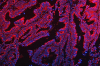 Immunofluorescent staining of FFPE human ovarian cancer tissue with TTC7B antibody (red) and DAPI nuclear stain (blue). HIER: steam section in pH8 EDTA buffer for 20 min.