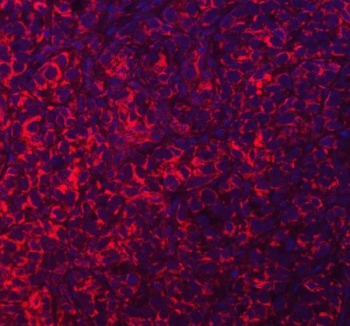 Immunofluorescent staining of FFPE human breast cancer tissue with Acyl-CoA dehydrogenase family member 9 antibody (red) and DAPI nuclear stain (blue). HIER: steam section in pH8 EDTA buffer for 20 min.