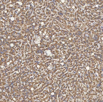 IHC staining of FFPE human liver cancer tissue with Sideroflexin-5 antibody. HIER: boil tissue sections in pH8 EDTA for 20 min and allow to cool before testing.