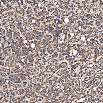 IHC staining of FFPE human liver cancer tissue with SH2D4A antibody. HIER: boil tissue sections in pH8 EDTA for 20 min and allow to cool before testing.