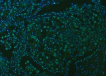 Immunofluorescent staining of FFPE human lung cancer tissue with U2 snRNP A antibody (green) and DAPI nuclear stain (blue). HIER: steam section in pH8 EDTA buffer for 20 min.