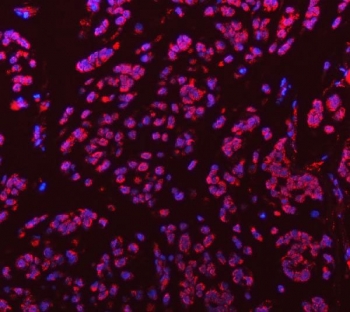 Immunofluorescent staining of FFPE human breast cancer tissue with Sm-D3 antibody (red) and DAPI nuclear stain (blue). HIER: steam section in pH8 EDTA buffer for 20 min.