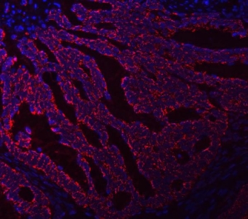 Immunofluorescent staining of FFPE human intestinal cancer tissue with ASNS antibody (red) and DAPI nuclear stain (blue). HIER: steam section in pH8 EDTA buffer for 20 min.