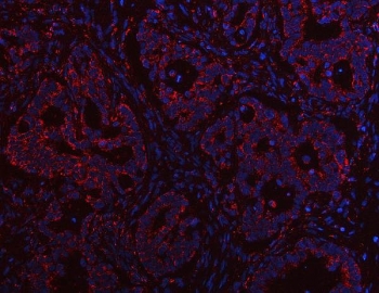 Immunofluorescent staining of FFPE human rectal cancer tissue with PTPIP51 antibody (red) and DAPI nuclear stain (blue). HIER: steam section in pH8 EDTA buffer for 20 min.