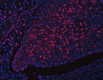 Immunofluorescent staining of FFPE human esophageal squamous cell carcinoma tissue with RFX1 antibody (red) and DAPI nuclear stain (blue). HIER: steam section in pH8 EDTA buffer for 20 min.