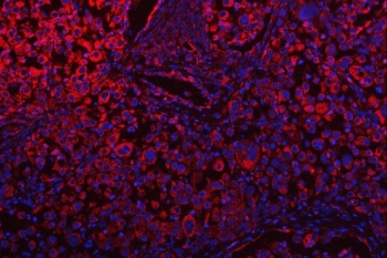 Immunofluorescent staining of FFPE human lung cancer tissue with OSGIN1 antibody (red) and DAPI nuclear stain (blue). HIER: steam section in pH8 EDTA buffer for 20 min.