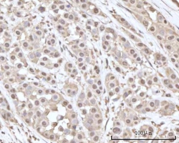 IHC staining of FFPE human breast cancer tissue with Recoverin antibody. HIER: boil tissue sections in pH8 EDTA for 20 min and allow to cool before testing.