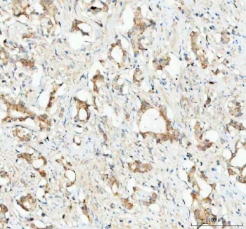 IHC staining of FFPE human prostatic acinar adenocarcinoma tissue with Glutathione Peroxidase 1 antibody. HIER: boil tissue sections in pH8 EDTA for 20 min and allow to cool before testing.