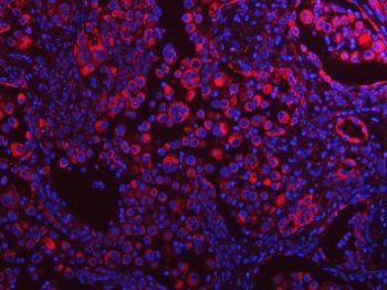Immunofluorescent staining of FFPE human lung cancer tissue with TAPP-1 antibody (red) and DAPI nuclear stain (blue). HIER: steam section in pH8 EDTA buffer for 20 min.