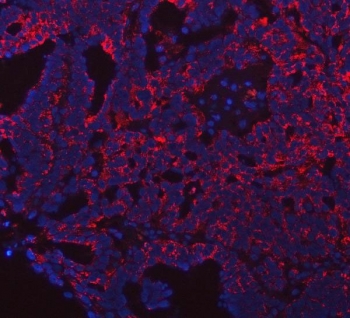 Immunofluorescent staining of FFPE human ovarian cancer tissue with PRDM15 antibody (red) and DAPI nuclear stain (blue). HIER: steam section in pH8 EDTA buffer for 20 min.