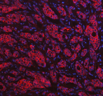 Immunofluorescent staining of FFPE human breast cancer tissue with HGPRTase antibody (red) and DAPI nuclear stain (blue). HIER: steam section in pH8 EDTA buffer for 20 min.