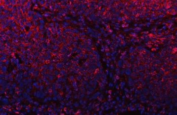 Immunofluorescent staining of FFPE human esophagus squama cancer tissue with PLD6 antibody (red) and DAPI nuclear stain (blue). HIER: steam section in pH6 citrate buffer for 20 min.