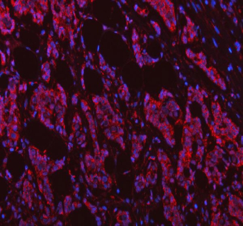 Immunofluorescent staining of FFPE human breast cancer tissue with NDUFB7 antibody (red) and DAPI nuclear stain (blue). HIER: steam section in pH6 citrate buffer for 20 min.