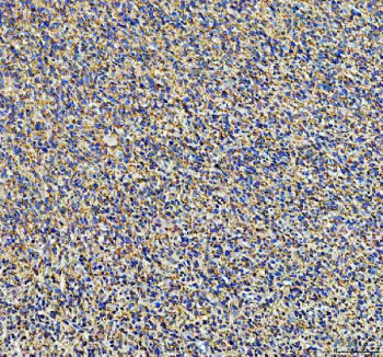 IHC staining of FFPE human glioma tissue with Ephrin Receptor B3 antibody, HRP-secondary and DAB substrate. HIER: boil tissue sections in pH8 EDTA for 20 min and allow to cool before testing.
